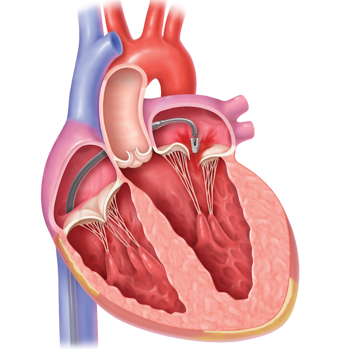 Best Mitral Valve Repair Doctors