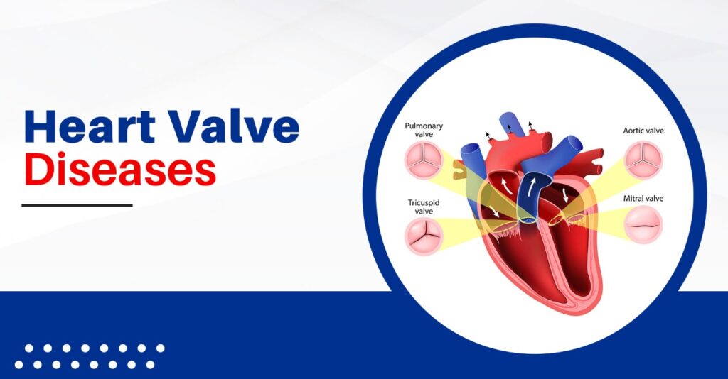 Heart Valve Disease Healingvalves