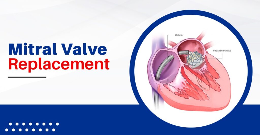 Mitral Valve Replacement - healingvalves